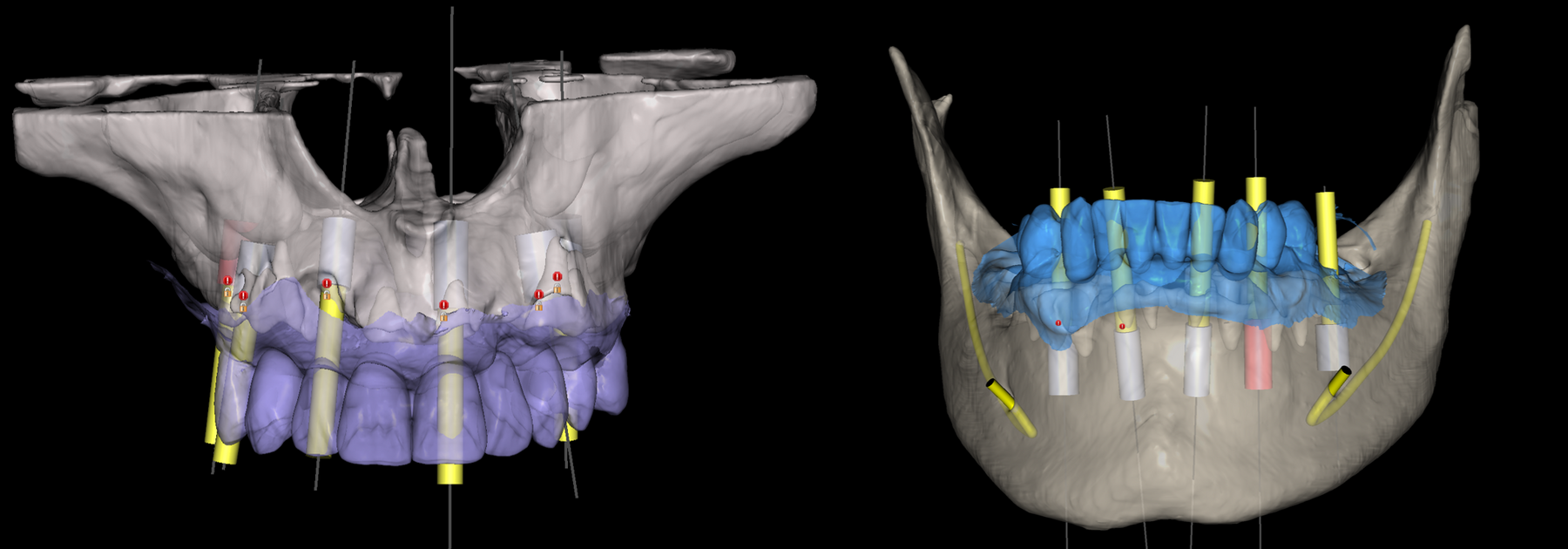 Full Arch Treatment Planning: FP1 or FP3?