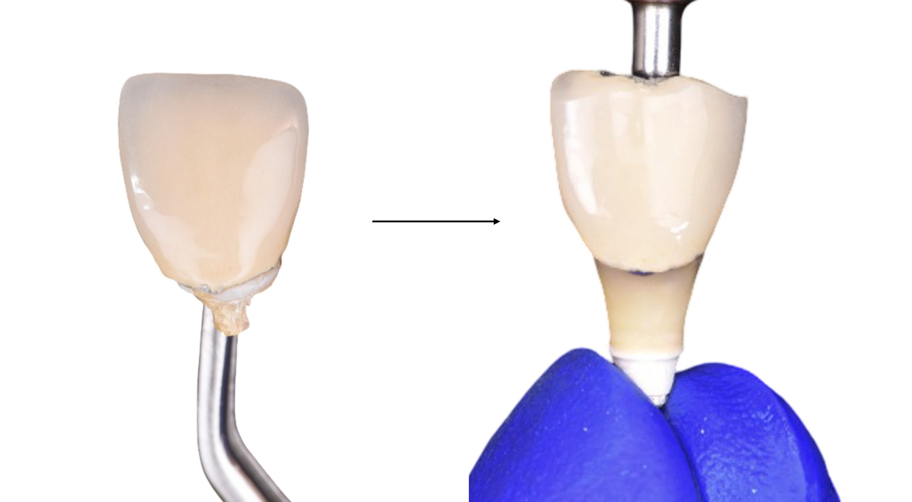 Anterior Immediate Implant Placement with CTG, GBR, and Fixed Provisionalization