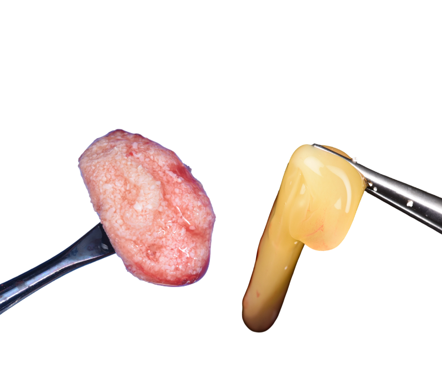 Management of Failed Implant #19 with GBR Using Sticky Bone