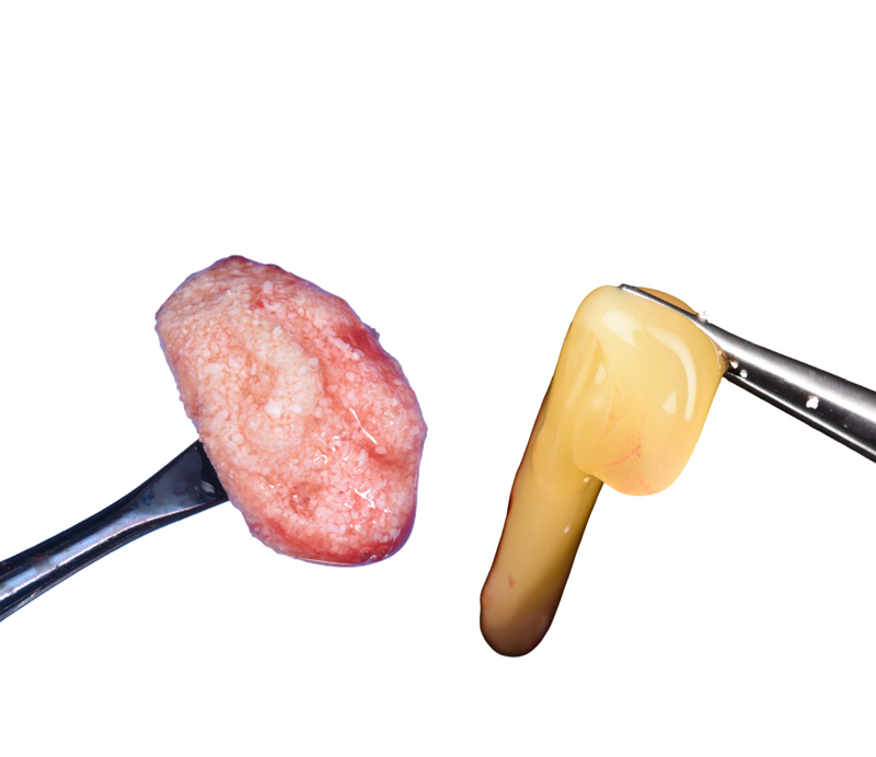 Management of Failed Implant #19 with GBR Using Sticky Bone
