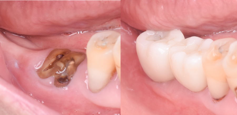 Immediate Implant Placement with Simultaneous Connective Tissue Grafting: 5 Year Clinical Outcome