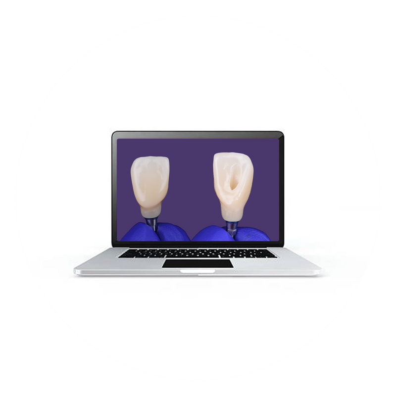 6. Screw-type Implant Crown (Anterior)