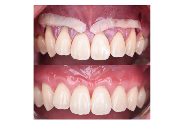Soft Tissue Grafting