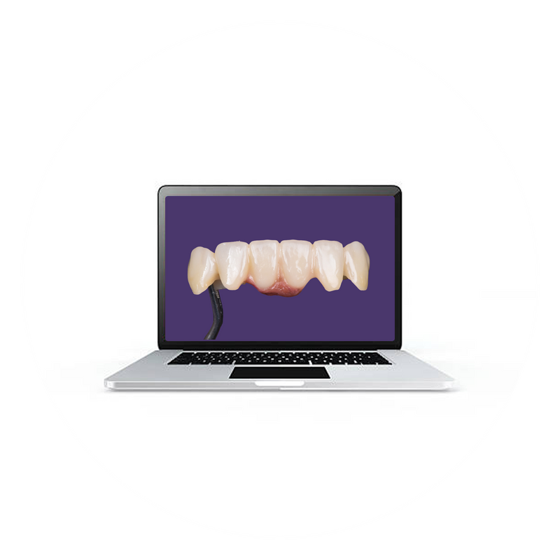 9.  Bridge with Gingiva Design
